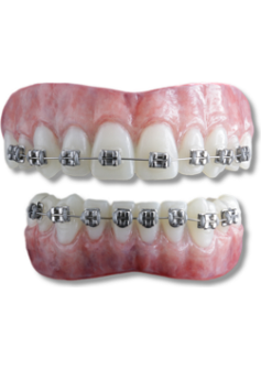 Anwen Silver Braces 1